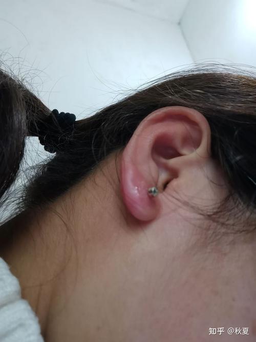 原来打完耳洞发炎也不是一件恐怖的事,首先要摆在自己的心态,不要害怕