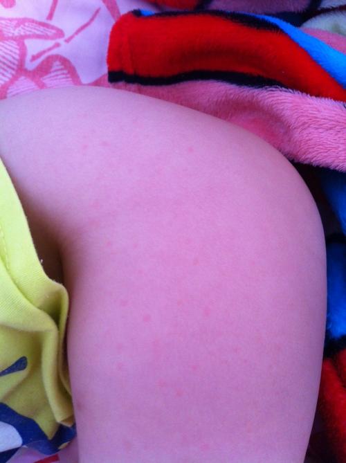 问:前天晚上孩子拉肚子,半夜又发烧,昨天去医院检查是胃肠感冒.