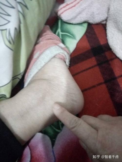 脚扭伤后5个月一直未愈?