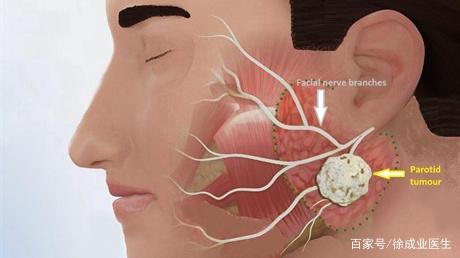 岳云鹏得过腮腺混合瘤!幸运的是他成功逃脱了面瘫风险!