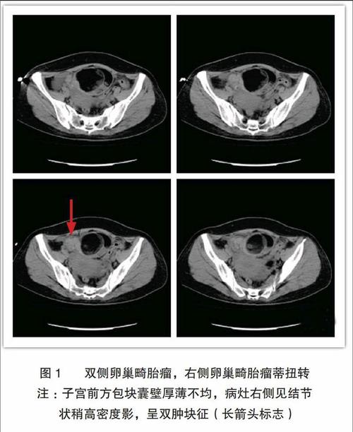 16排螺旋ct对卵巢肿物蒂扭转的诊断