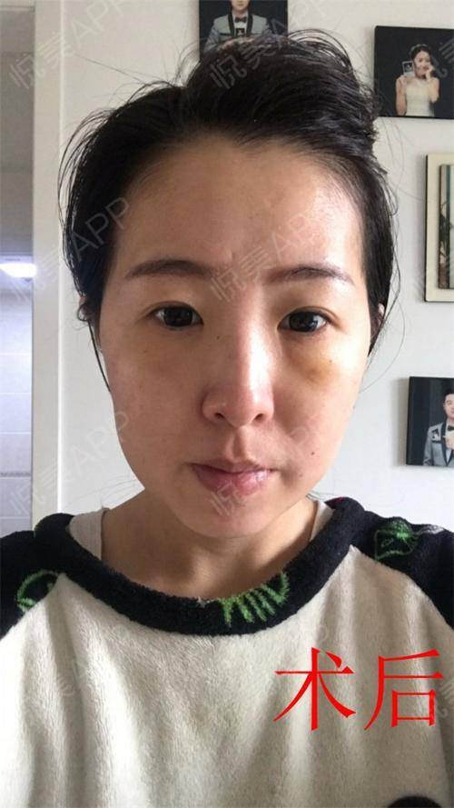 自体脂肪填泪沟术后3天_激光去眼袋术后3天_内切去眼袋术后3天_面部