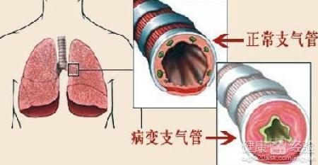 支气管肺炎用什么药