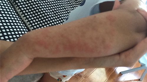 儿子沙土皮炎,儿研所开了***,还有艾洛松,涂了一个星期了