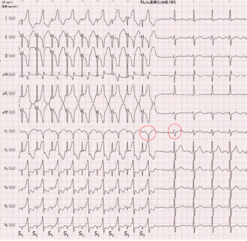 【2020学术荟萃】预激综合征心电图 少见表现与诊断思路