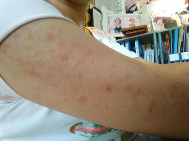 嗜酸性脓疱性毛囊炎的患者,背部面部都会瘙痒,早发现