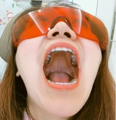 上海牙齿矫正患者舌侧牙套经历