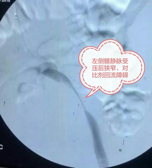 髂静脉压迫综合征