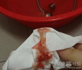 宫颈炎出血的原因是什么