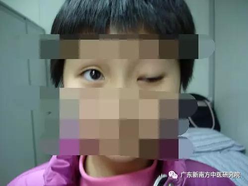 78岁的梁婆婆,被女儿发现不停眨眼睛,社区医院诊断为眼肌痉挛,针灸