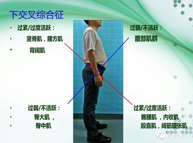 脊柱功能与结构,上下交叉综合征讲解