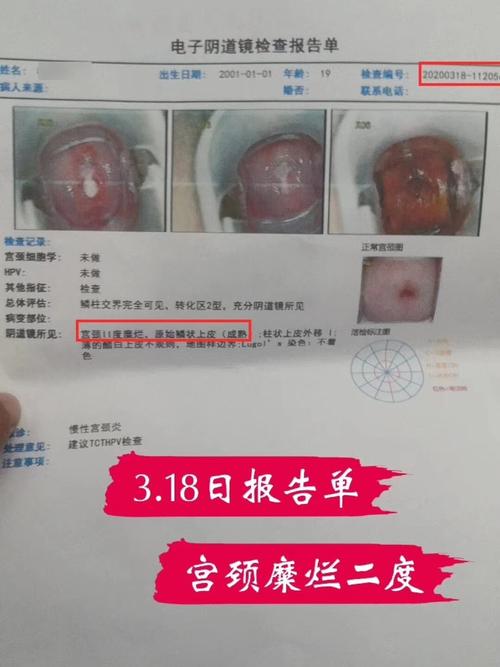 这么多年宫颈糜烂终于好了_宫颈糜烂_hpv_医疗健康
