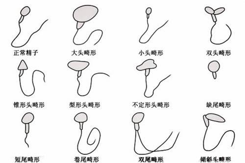 畸形精子长成什么样子你知道吗?备孕的男性要注意了!