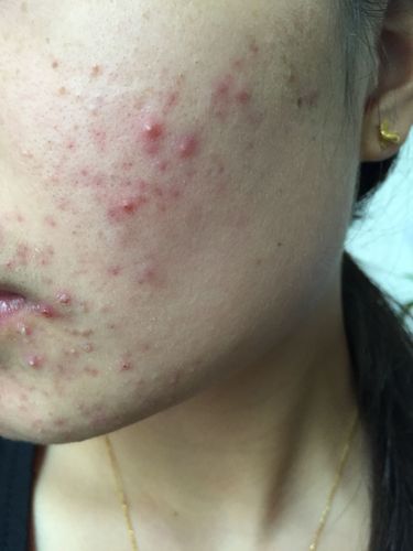 这满脸的痘痘长了两个月了,吃中药一点用没有