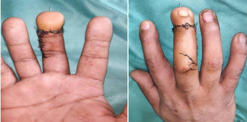 男子施工致手指末节离断,手指再造术助他圆残缺之憾