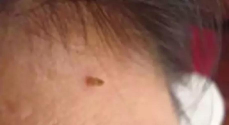 脖子长小肉粒的留意了!