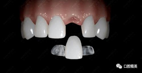 粘接固定桥及其设计要领