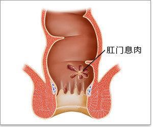 肛门息肉