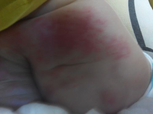 家里八个月女婴屁股上面有块红肿.不知道是什么病?办?