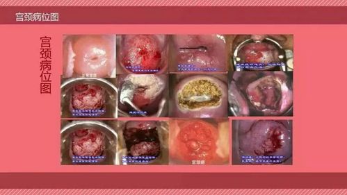 写美篇 宫颈糜烂一度:指溃烂面积在宫颈口的三分之一,呈颗粒状; 宫颈