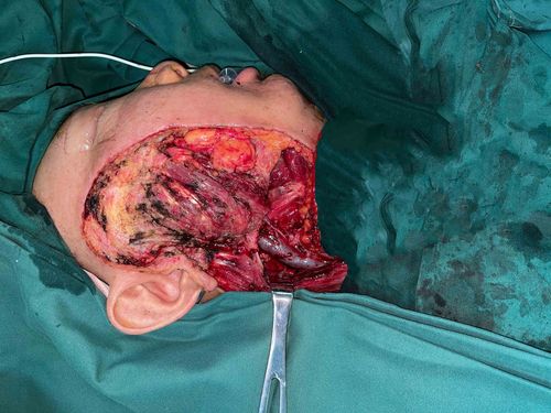 腮腺癌术后修复