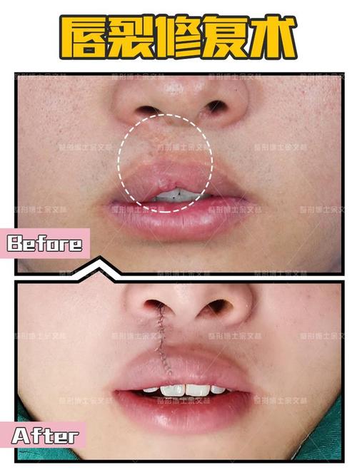 【案例赏析】唇裂术后必须进行二次手术?