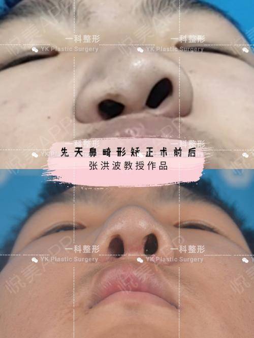 先天鼻子畸形怎么办
