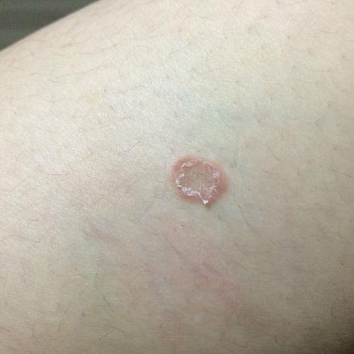 这个像是梅毒潜伏期的症状吗?