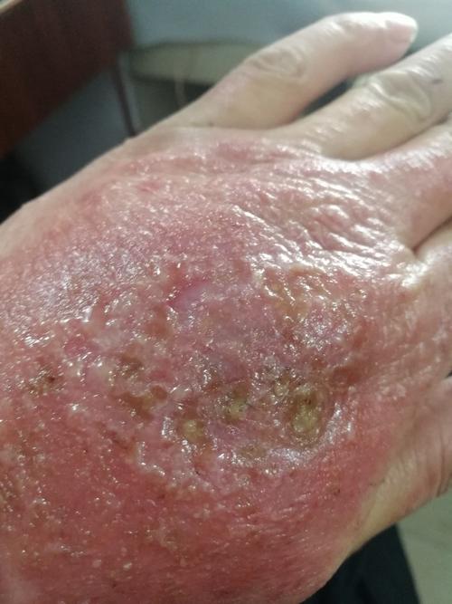 可怕的湿疹严重困扰了我一年多,终于有些好转,见人可以大胆伸出手来了