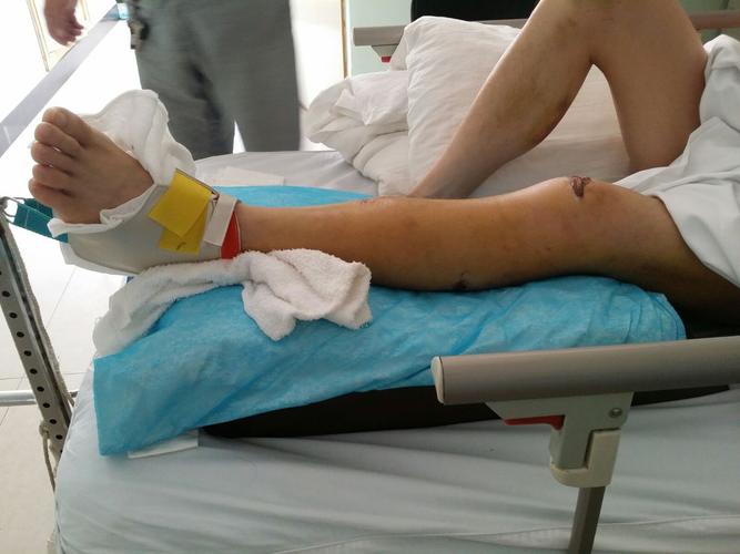 治疗方案: 1,先行胫腓骨骨折手术复位内固定治疗,术后长腿石膏膝关节