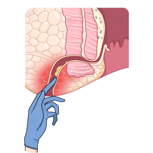 裤子脱了腿张开!医院让人脸红的"肛门指检",竟能查出这么多病