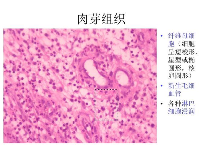 肉芽组织   纤维母细 胞(细胞 呈短梭形, 星型或椭 圆形,核 卵圆形)
