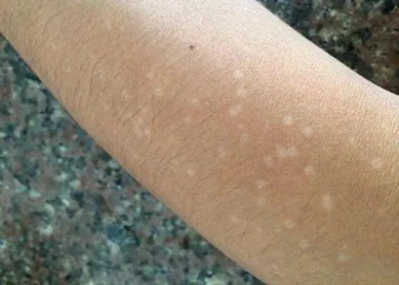 是不是白色糠疹?这些白斑,你分辨的清吗?