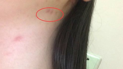 淋巴癌早期难以发现,只要身上出现这种疙瘩,说明体内有癌细胞了