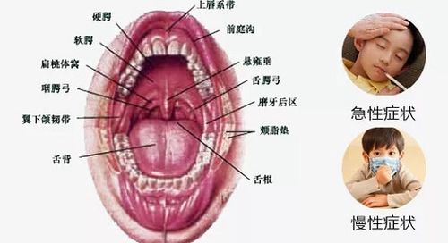 了解扁桃体炎复发的原因才能更好的预防和治疗