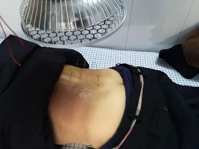 巨鹿县中医院康复科神奇的针灸之钩活术
