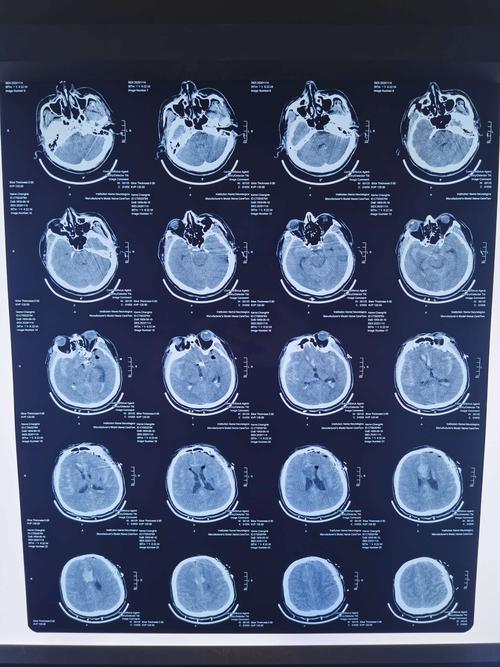 常和,男,61,蛛网膜下腔出血,前交通动脉瘤