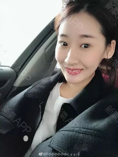 侧面比牙套之前好看了很多以前都是笑不露齿现在终于敢张嘴大笑了