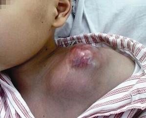 恶性肉瘤 不知道能不能治愈呢