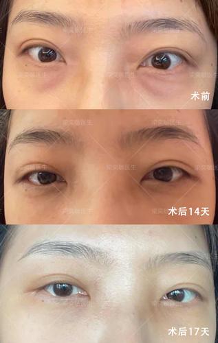 内切眼袋术后2周恢复效果