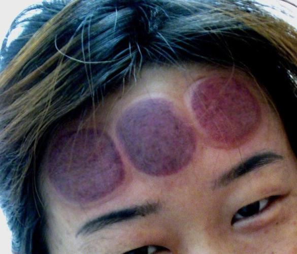 揪痧拔罐释疑四十三关于脑门拔罐和挤痧