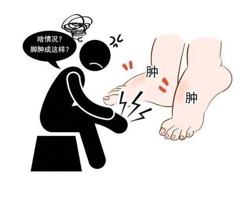 不要慌,一分钟带你了解水肿的原因.