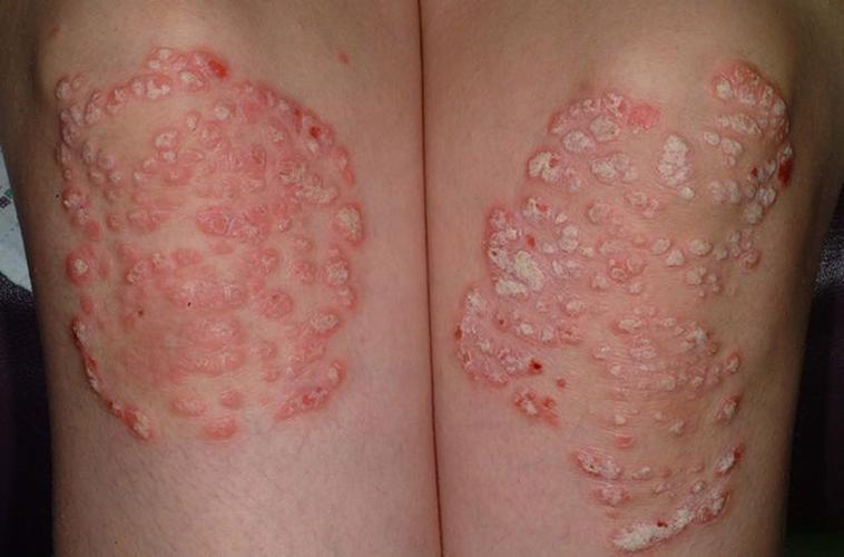 这是一种常见的与遗传及免疫异常有关的,慢性红斑脱屑性炎症性皮肤病