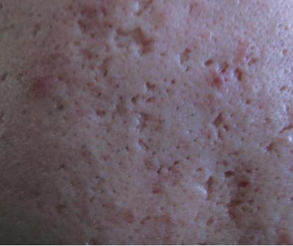 壹知肤如何科学有效的改善痘印痘坑