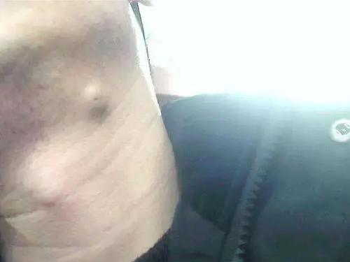 肿物呈球形,单发或多发,大小不等,小者数毫米,大者近10厘米.