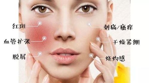 除了最客观的换季温度变化诱发或加重皮肤敏感,遗传,性别,年龄等是