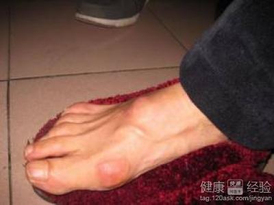 右窝腱鞘囊肿术后需要注意什么