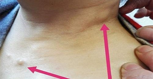 身上长了这种「结节」,千万不要大意,极有可能就是「癌症皮肤转移」!