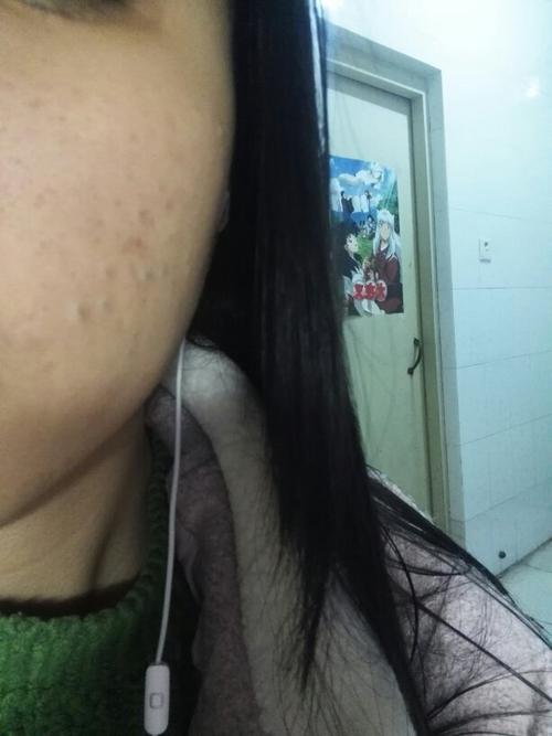 痘痘上有黑点似的东西怎么回事啊,属于什么痘啊