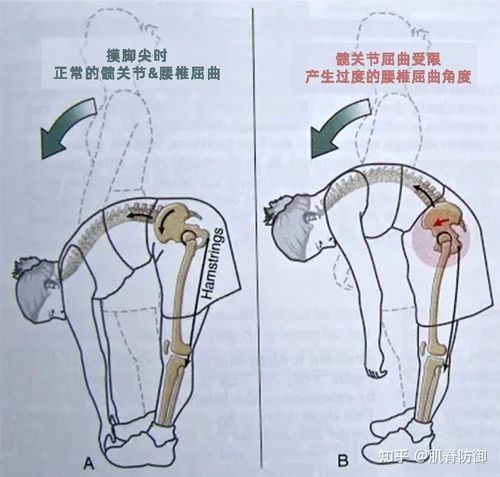 髋关节活动受限,只能靠腰椎弯曲代偿